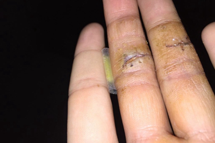 割伤手指头有口子图