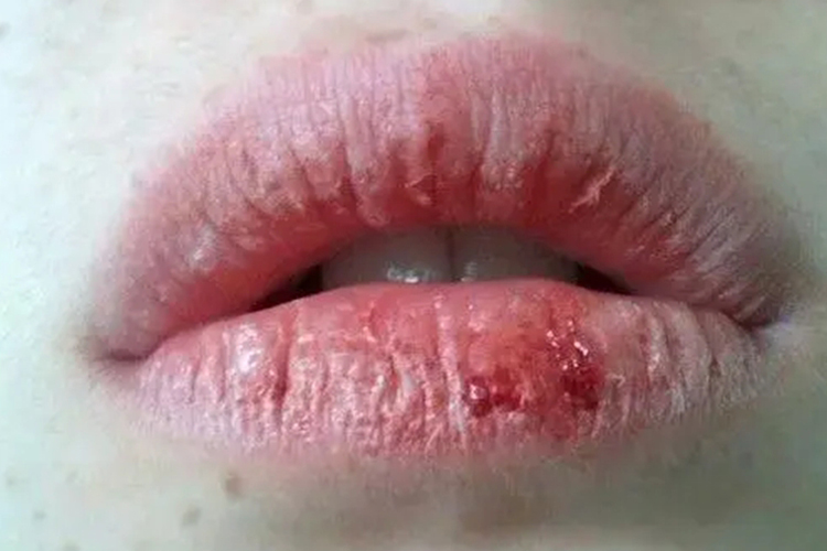 嘴唇糜烂症状图片图片
