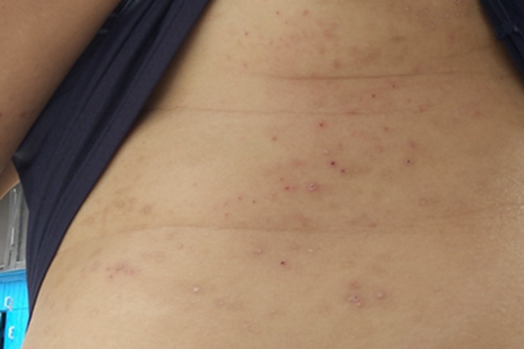 虫咬皮炎腹部红点图 虫咬皮炎腹部红点图