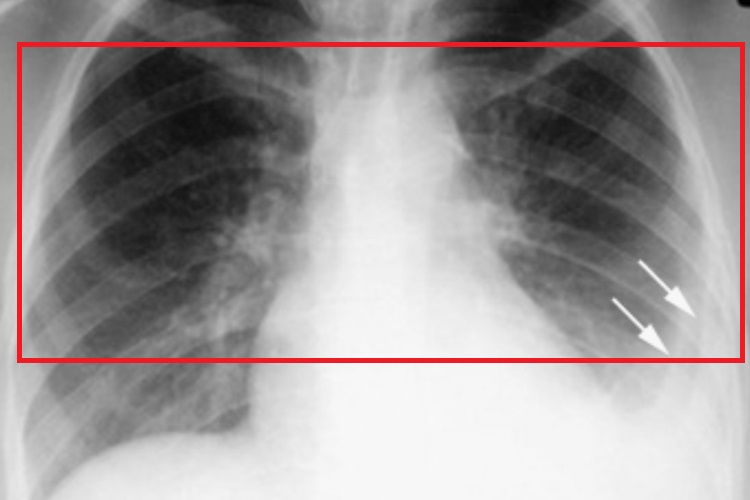 原发性肺结核X线表现图 原发性肺结核X线表现图