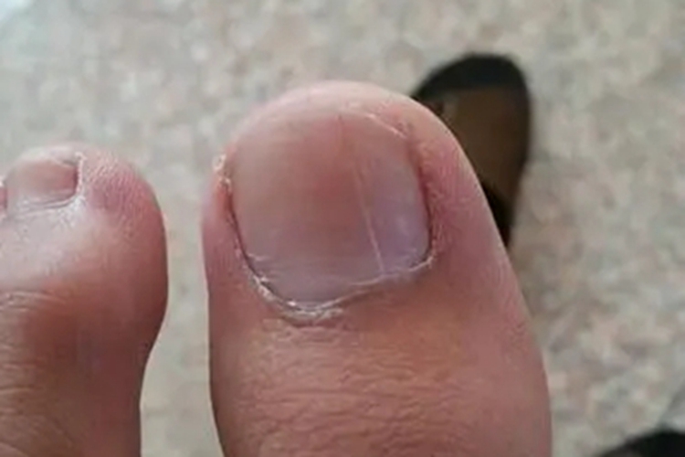 甲营养不良脚趾甲症状图