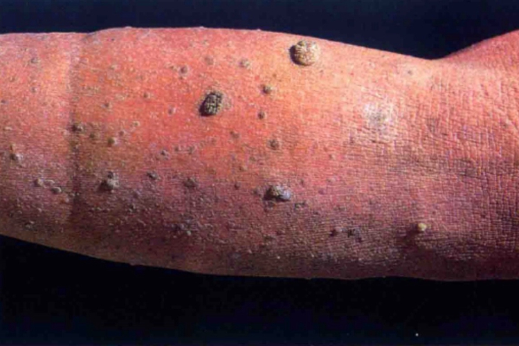 黑棘皮病小腿疙瘩图