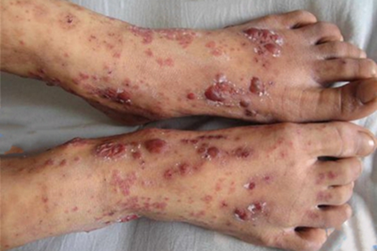 变应性皮肤血管炎脚背紫斑图