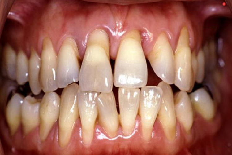 牙根严重外露图