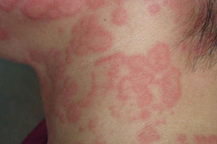 皮肤过敏红肿颈部长小红疙瘩图