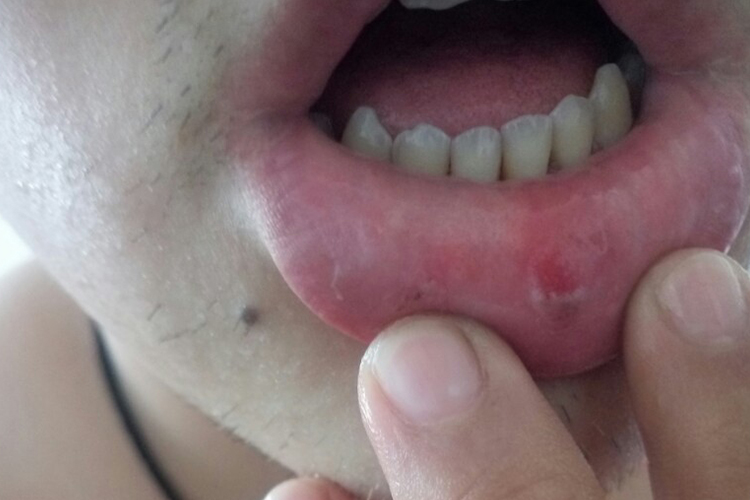 口腔梅毒硬下疳图