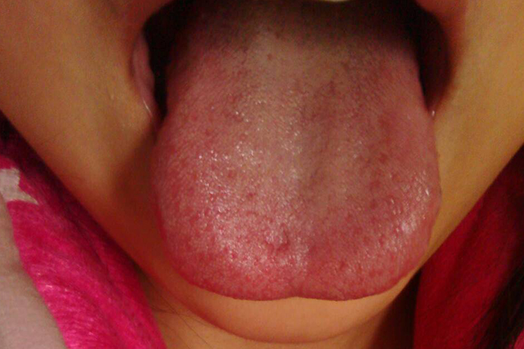 儿童血热舌头图 儿童血热舌头图