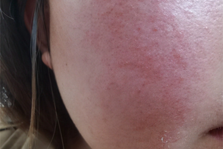 丘疹脓疱型酒糟鼻红点图