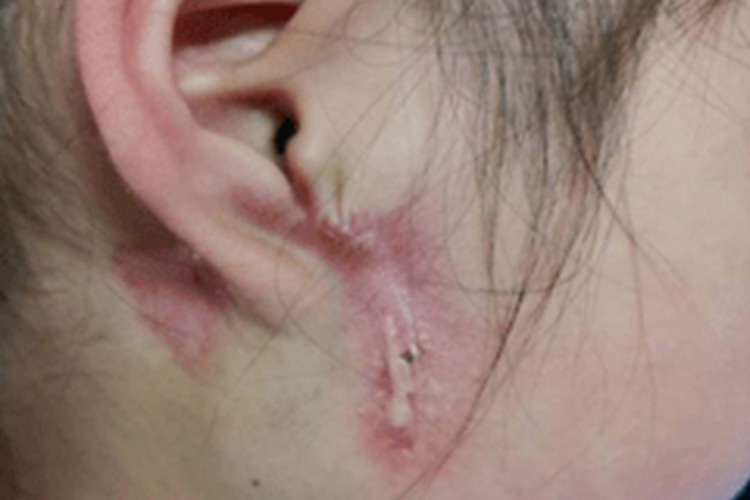 先天性鳃裂瘘管图