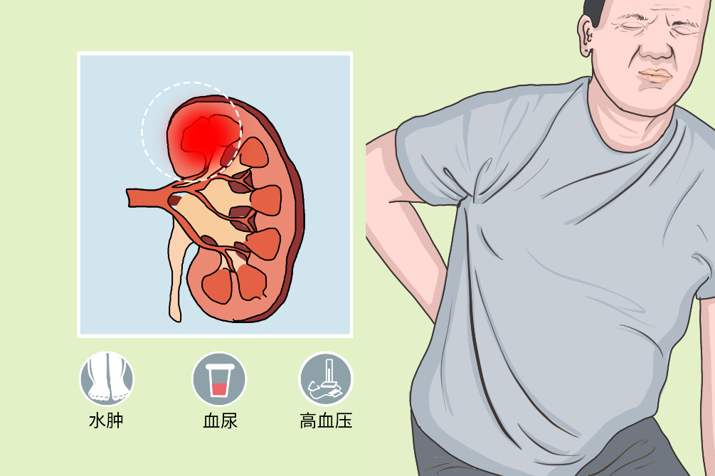 急性肾炎综合征图