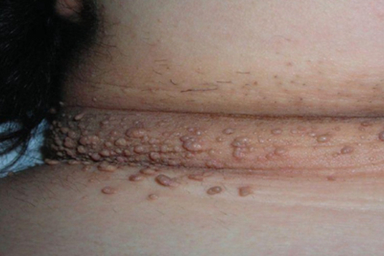 恶性黑棘皮病颈部皮肤颜色加深图 恶性黑棘皮病颈部皮肤颜色加深图