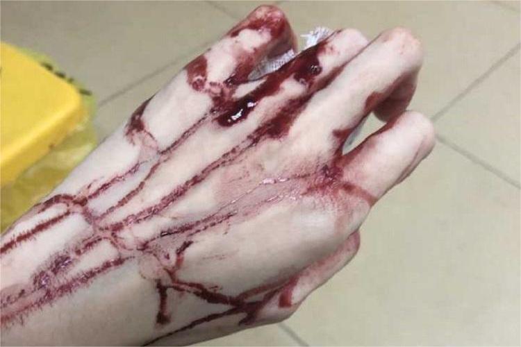 手流血苍白图