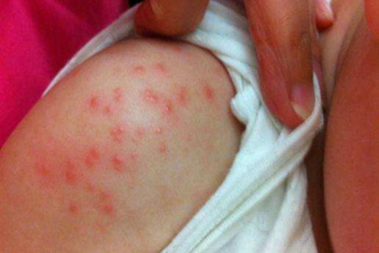 渗出型婴儿湿疹肩部症状图