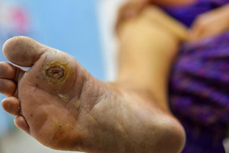 糖尿病性皮肤病脚底溃疡图