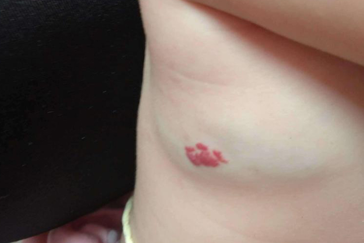 混合型血管瘤图 混合型血管瘤图