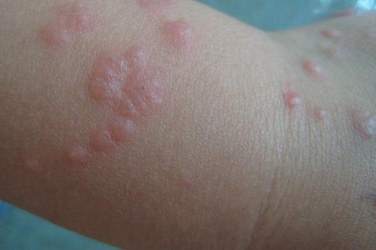 螨虫疙瘩图 螨虫疙瘩图