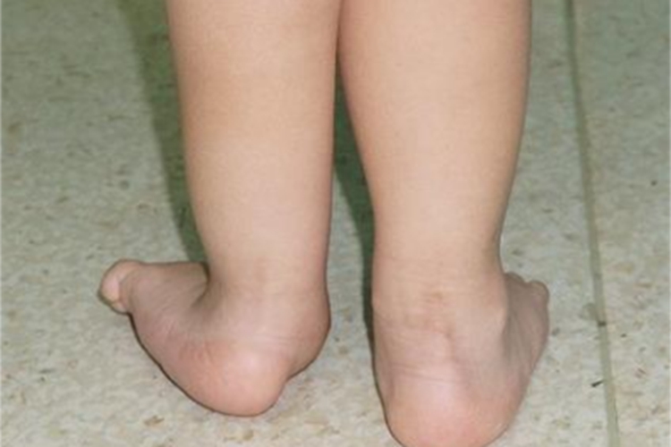 先天性腓骨缺如脚踝畸形图 先天性腓骨缺如脚踝畸形图
