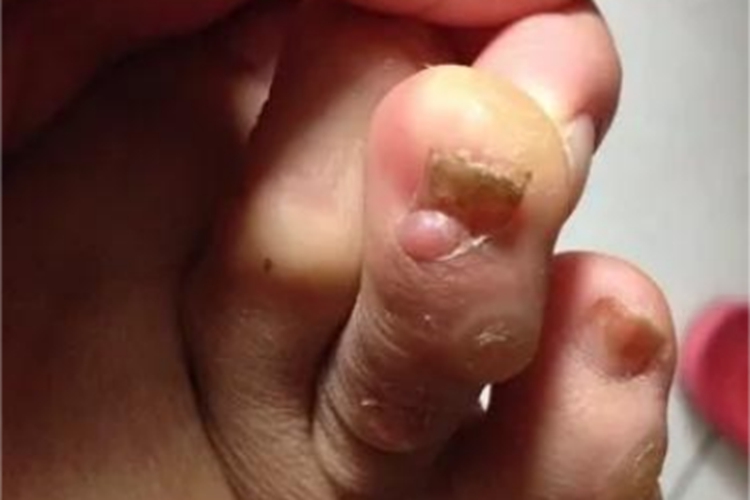 结节性硬化症脚趾甲肉球图 结节性硬化症脚趾甲肉球图