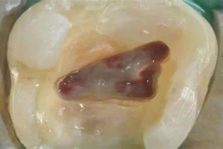 上颌磨牙开髓洞形图