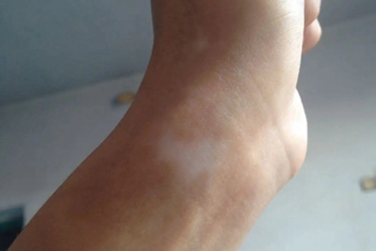 进展期节段型白癜风手腕症状图 进展期节段型白癜风手腕症状图