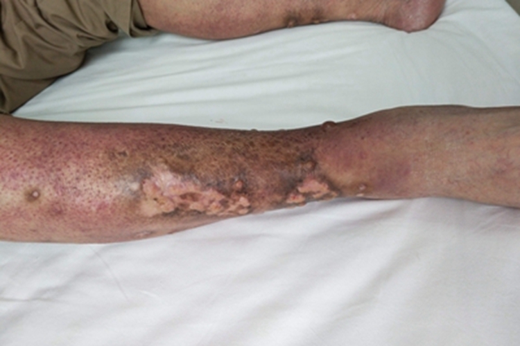 血栓闭塞性脉管炎小腿溃疡图