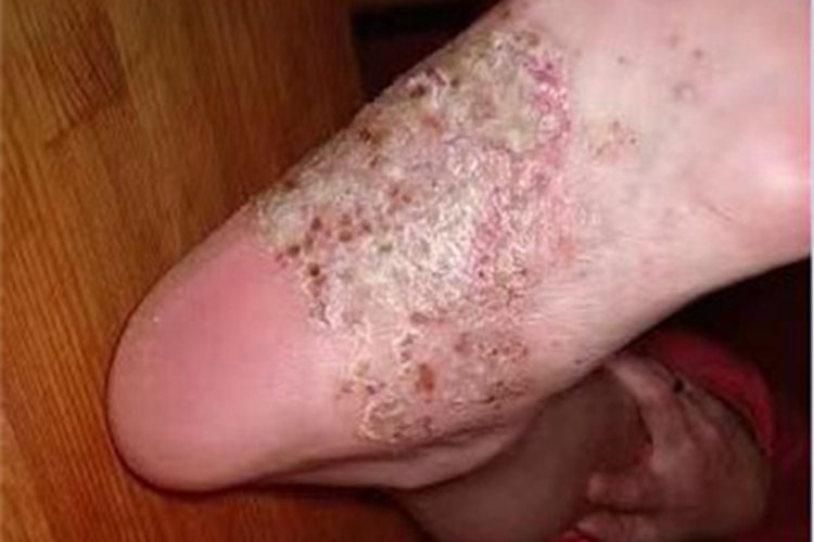 局限性脓疱型银屑病脚底脱皮图
