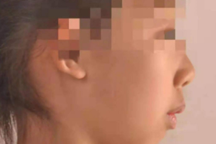 上颌前突上嘴唇突出图