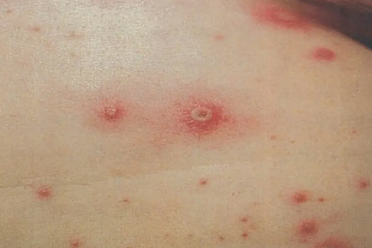 水痘局部化脓图