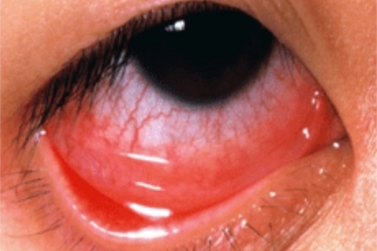 儿童过敏性结膜炎结膜症状图 儿童过敏性结膜炎结膜症状图