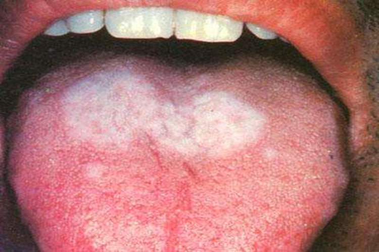 口腔扁平苔藓图