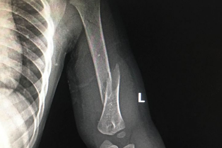 肱骨骨折重叠移位图 肱骨骨折重叠移位图
