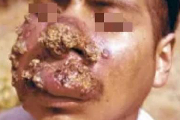 利什曼病面部黄痂图