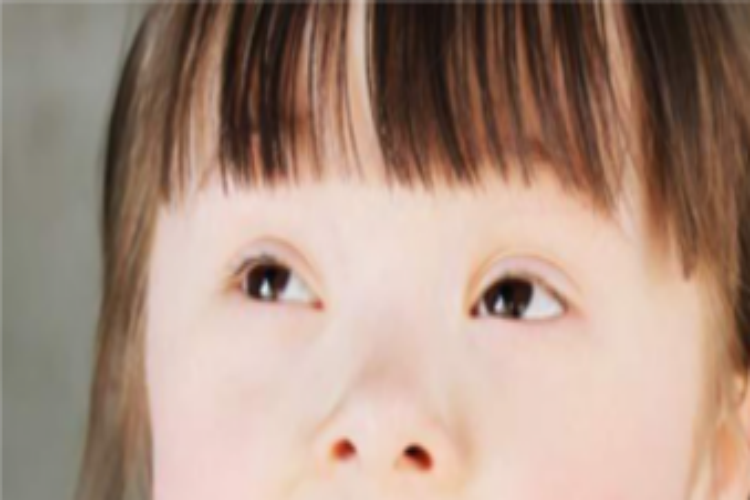 唐氏综合征鼻子像马鞍图