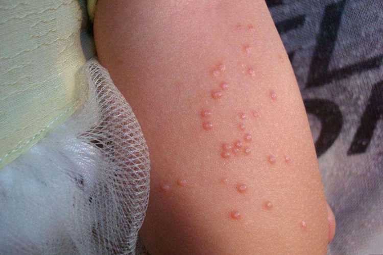 手臂上传染性软疣图