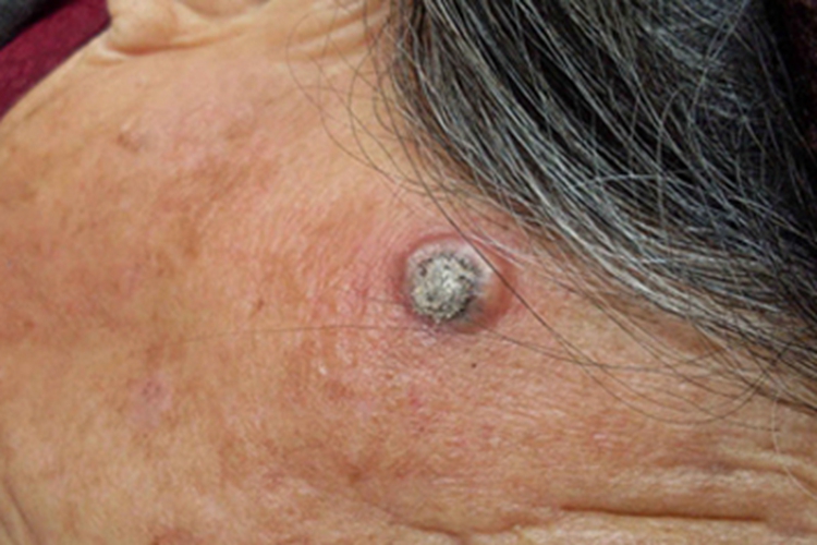 毛鞘棘皮瘤结节图