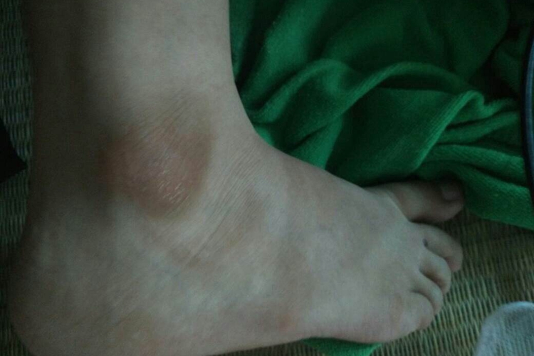 摩擦黑皮病脚踝黑色素沉着图