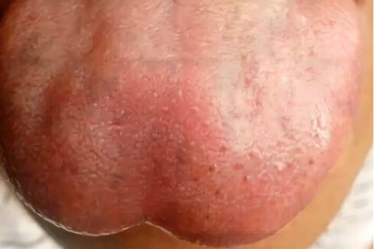 舌尖凹陷图 舌尖凹陷图