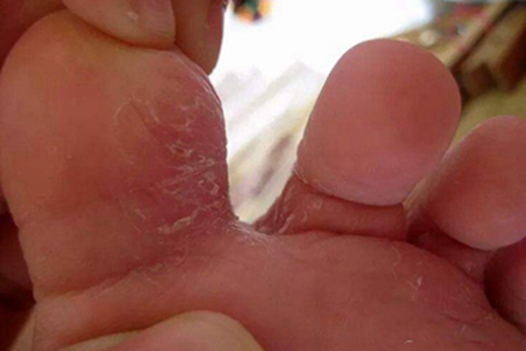 浸渍糜烂型足癣脚趾脱皮图