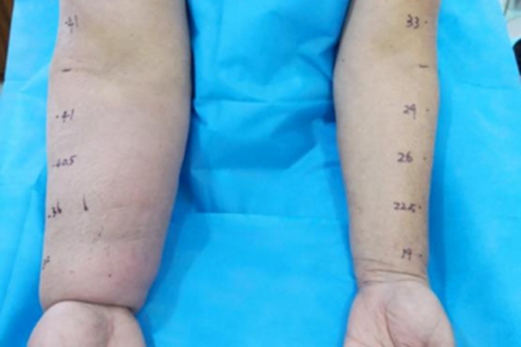 淋巴水肿肿胀图