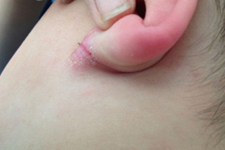 外耳湿疹耳周皮肤发红开裂图 外耳湿疹耳周皮肤发红开裂图