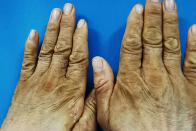 手部湿疹皮肤粗糙肥厚图 手部湿疹皮肤粗糙肥厚图