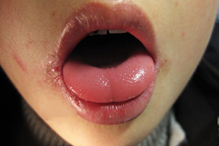 核黄素缺乏症皲裂图