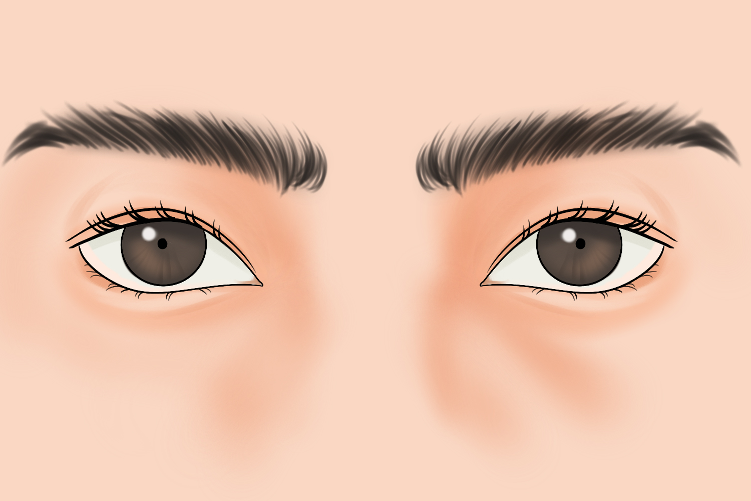 阿罗氏瞳孔图 阿罗氏瞳孔图