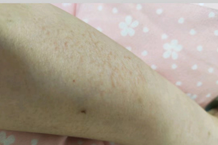 冬季瘙痒症胳膊裂纹图