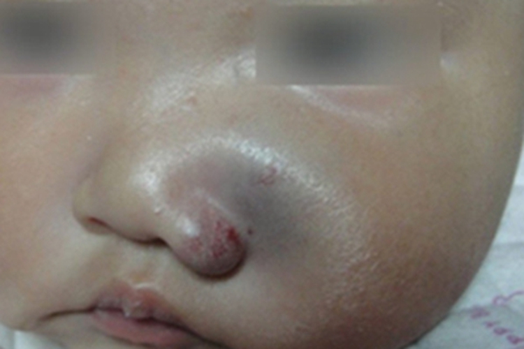 深在型婴儿血管瘤图 深在型婴儿血管瘤图