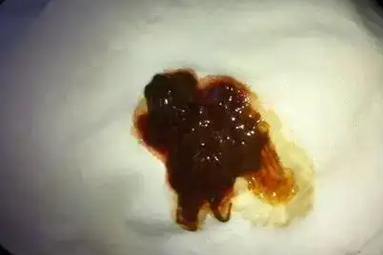 肠癌血便伴有黏液图