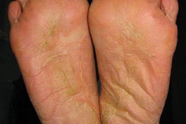 弥漫性掌跖角化病脚底皮肤粗糙图