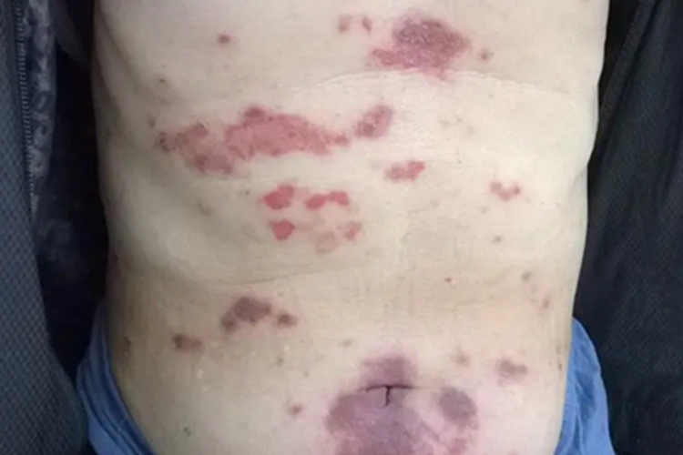 副肿瘤性天疱疮腹部结痂图