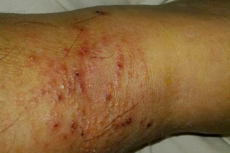 小腿接触性皮炎图 小腿接触性皮炎图