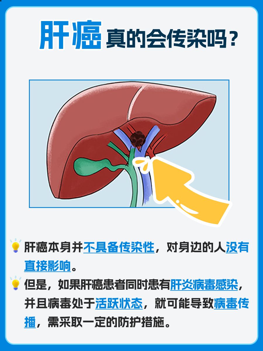 肝癌“会传染”？对身边人有影响？别恐慌！